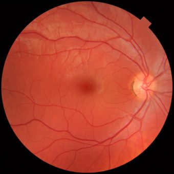 retina-photo-wink-optometry
