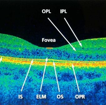 OCT-layers-wink-optometry