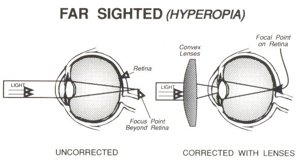 far-sighted-wink-optometry