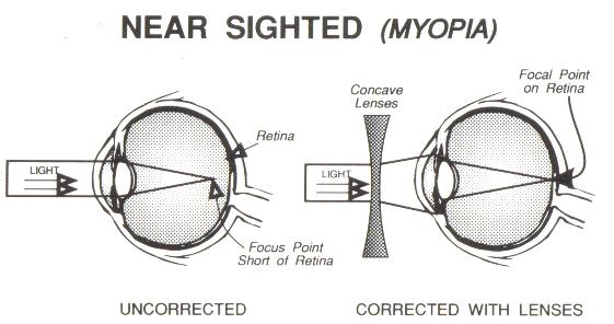 near-sighted-wink-optometry