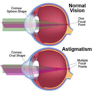 astigmatism-wink-optometry