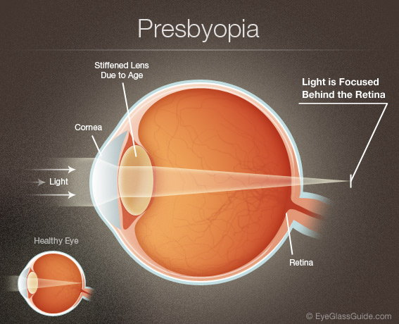 presbyopia-wink-optometry