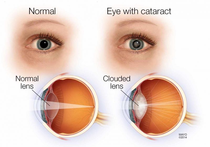 normal-eye-cataract